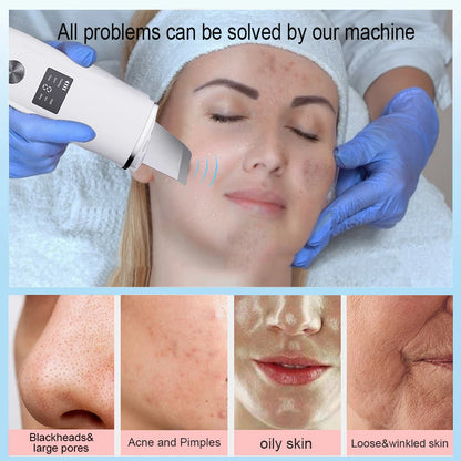 Ultrasonic Face Scrubber/ Peeling